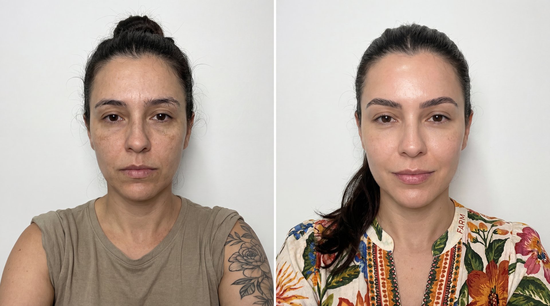 Peeling químico na Lyvera Clinique